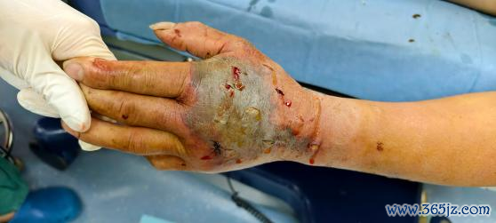 大爷杀死剧毒眼镜蛇 被离断蛇头咬伤 生死一线间的惊险救援